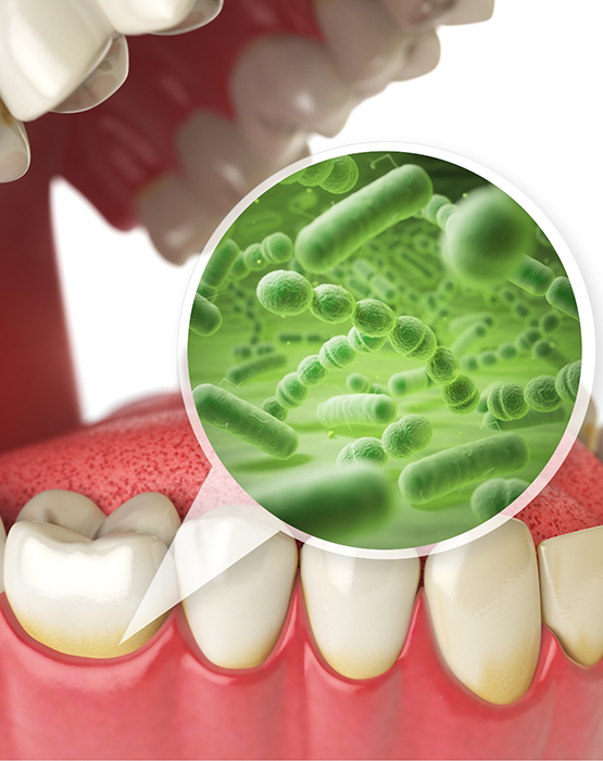 Illustration of bacteria in the gums