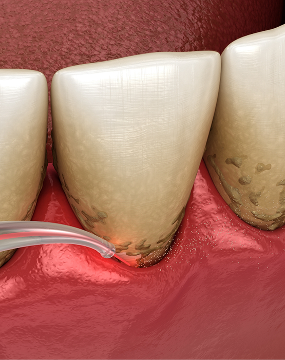 Illustration of teeth in lower arch receiving laser treatment
