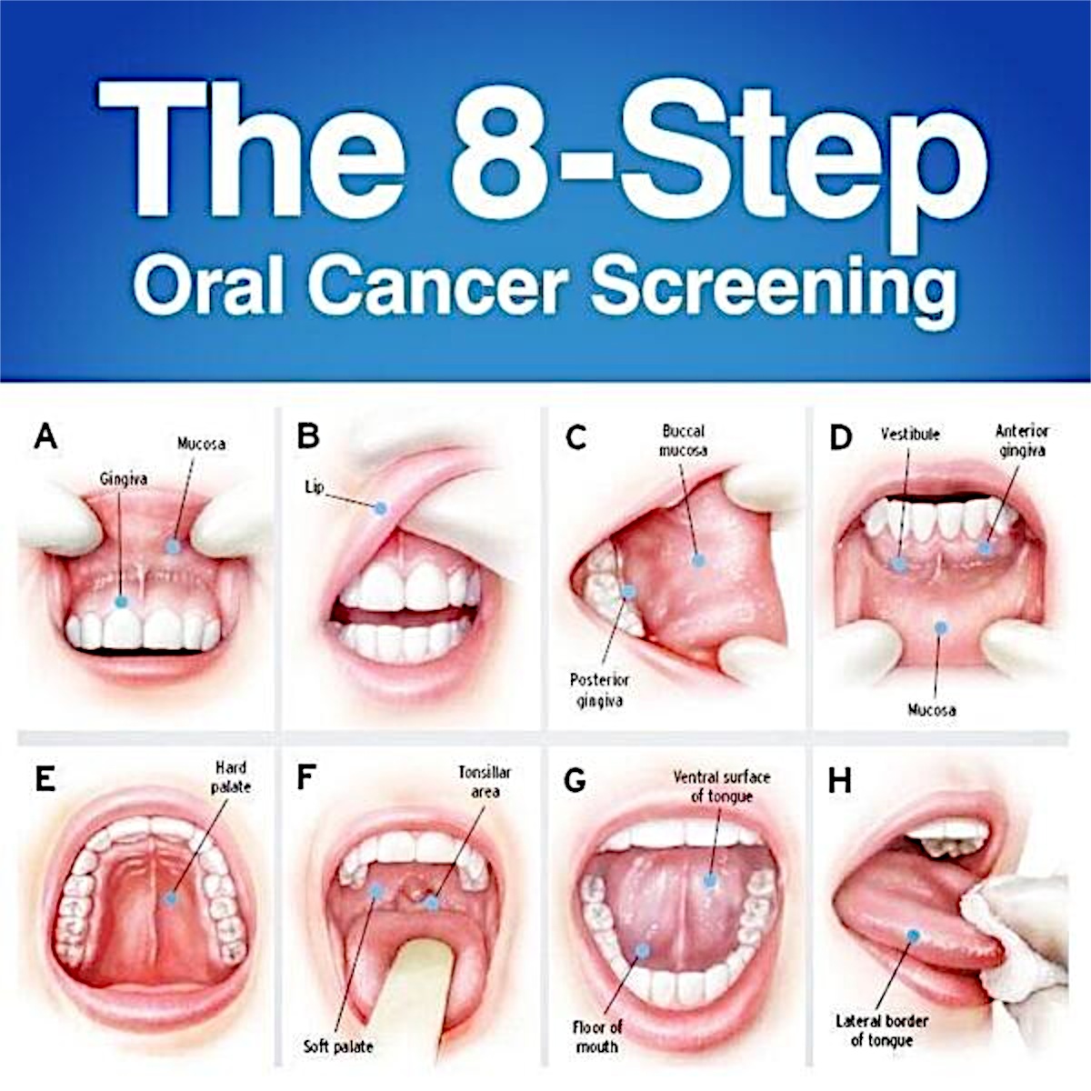 Oral Cancer 1 