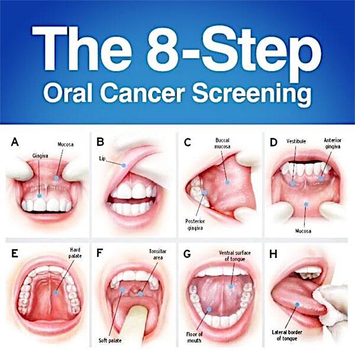 Oral cancer Spruce Ridge Dental Blog Spruce Ridge Dental Blog